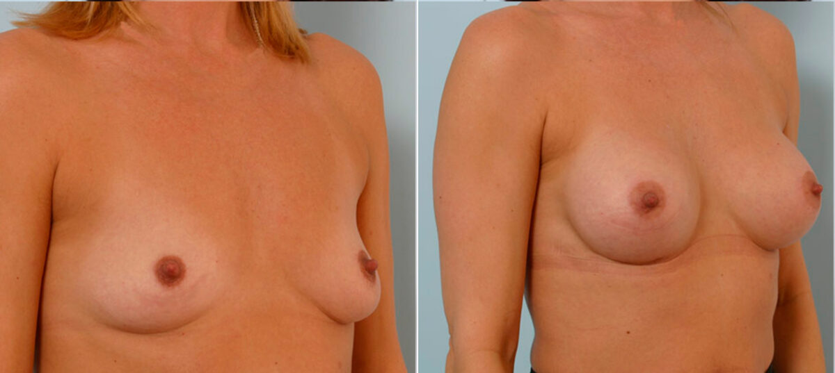 Breast Augmentation before and after photos in Houston, TX, Patient 24981