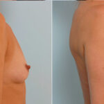 Breast Augmentation before and after photos in Houston, TX, Patient 24981