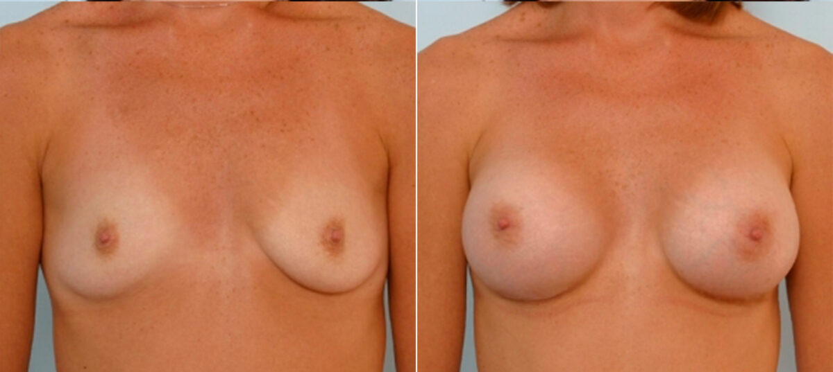 Breast Augmentation before and after photos in Houston, TX, Patient 24988