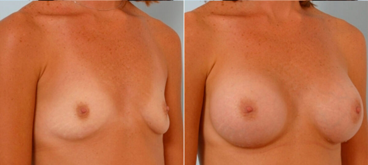 Breast Augmentation before and after photos in Houston, TX, Patient 24988