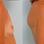 Breast Augmentation before and after photos in Houston, TX, Patient 24988