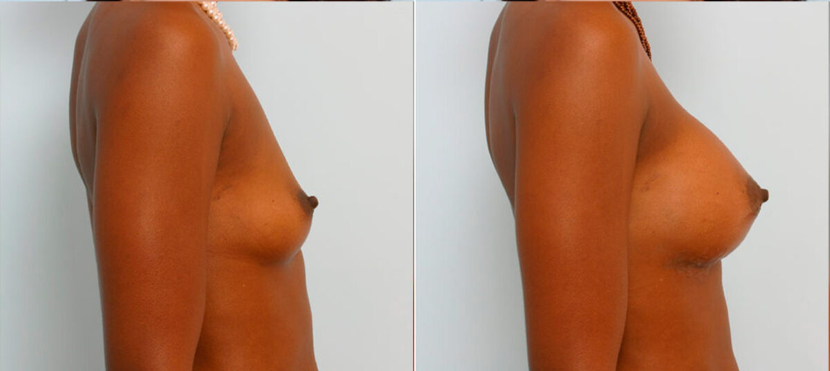 Breast Augmentation before and after photos in Houston, TX, Patient 24995