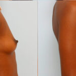 Breast Augmentation before and after photos in Houston, TX, Patient 24995