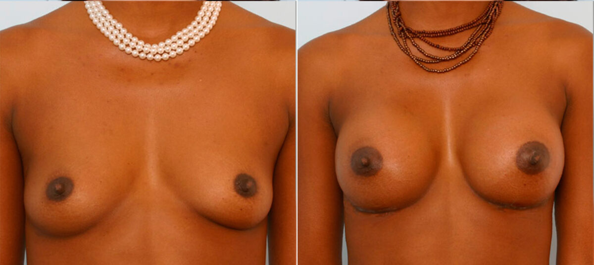 Breast Augmentation before and after photos in Houston, TX, Patient 24995