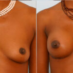 Breast Augmentation before and after photos in Houston, TX, Patient 24995