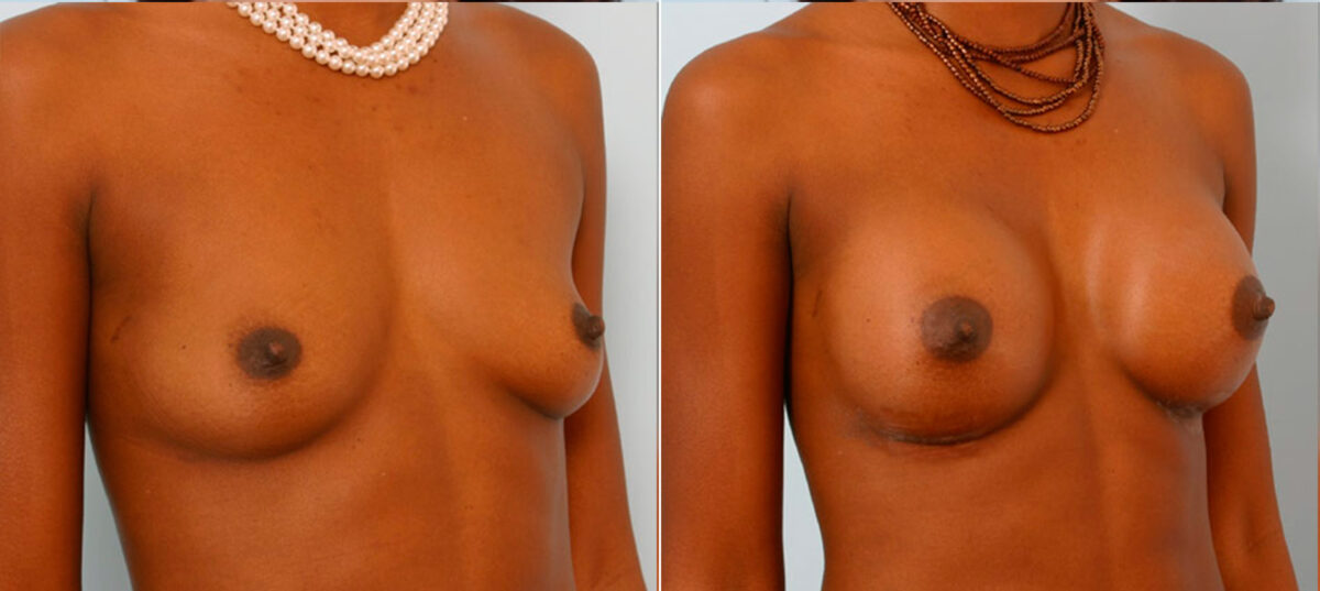 Breast Augmentation before and after photos in Houston, TX, Patient 24995
