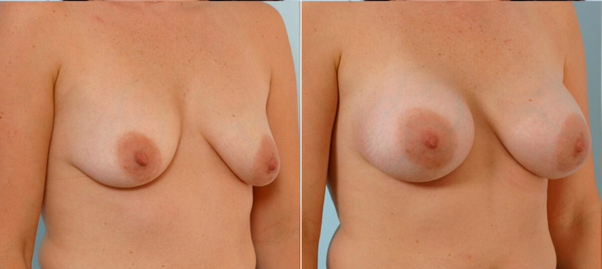 Breast Augmentation before and after photos in Houston, TX, Patient 25002