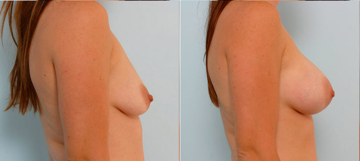 Breast Augmentation before and after photos in Houston, TX, Patient 25002