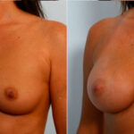 Breast Augmentation before and after photos in Houston, TX, Patient 25009
