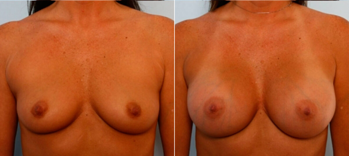 Breast Augmentation before and after photos in Houston, TX, Patient 25009