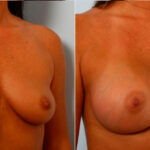 Breast Augmentation before and after photos in Houston, TX, Patient 25009