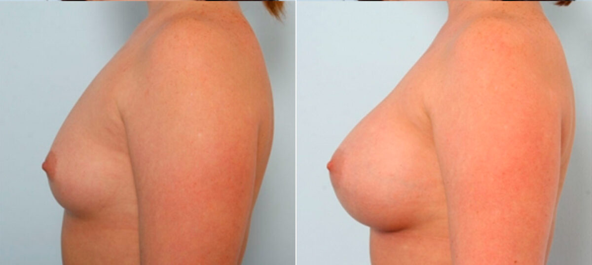 Breast Augmentation before and after photos in Houston, TX, Patient 25020