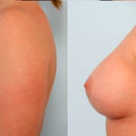 Breast Augmentation before and after photos in Houston, TX, Patient 25020