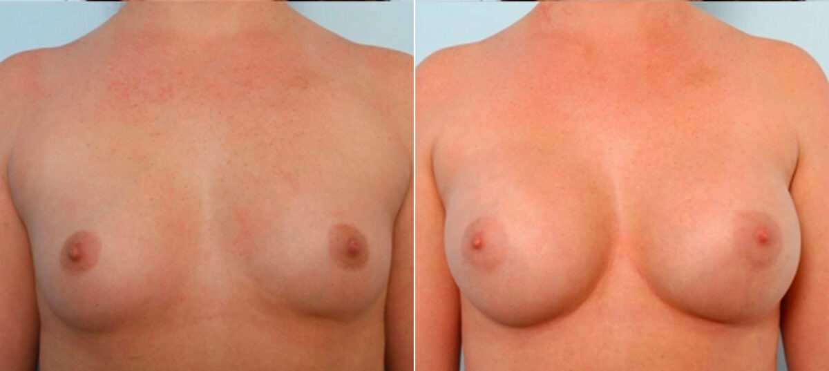 Breast Augmentation before and after photos in Houston, TX, Patient 25020