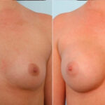 Breast Augmentation before and after photos in Houston, TX, Patient 25020