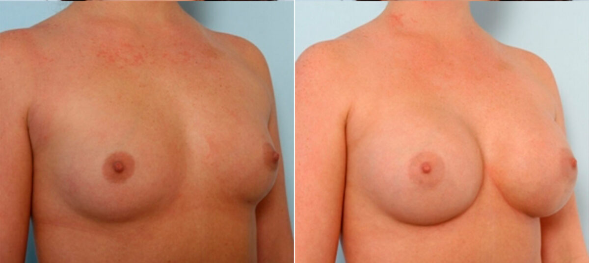 Breast Augmentation before and after photos in Houston, TX, Patient 25020