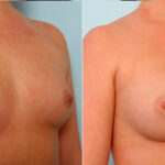 Breast Augmentation before and after photos in Houston, TX, Patient 25020