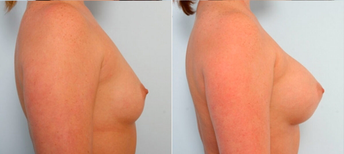 Breast Augmentation before and after photos in Houston, TX, Patient 25020