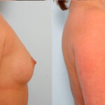 Breast Augmentation before and after photos in Houston, TX, Patient 25020
