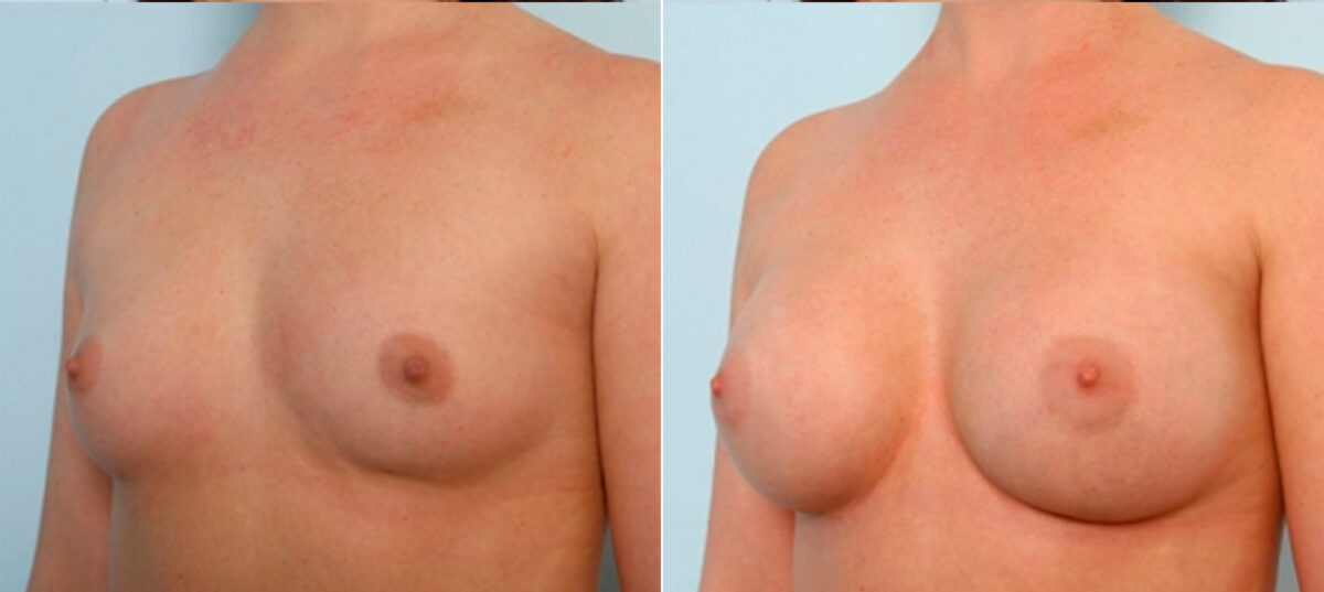 Breast Augmentation before and after photos in Houston, TX, Patient 25020