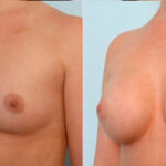 Breast Augmentation before and after photos in Houston, TX, Patient 25020