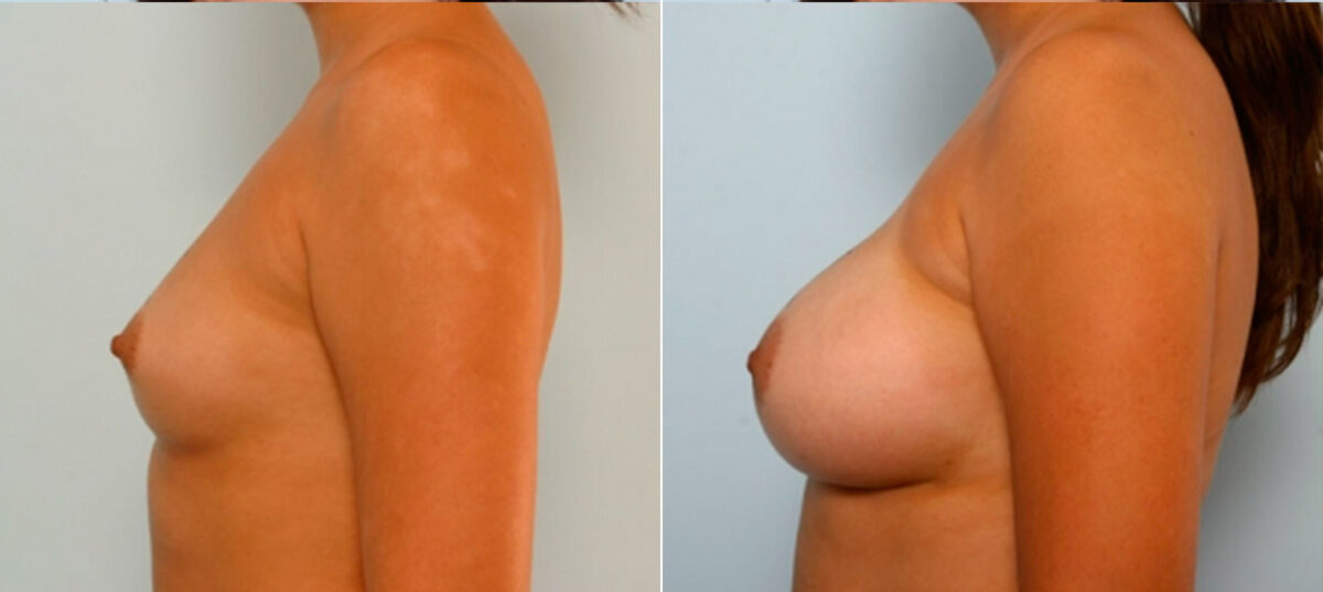 Breast Augmentation before and after photos in Houston, TX, Patient 25031