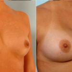 Breast Augmentation before and after photos in Houston, TX, Patient 25031