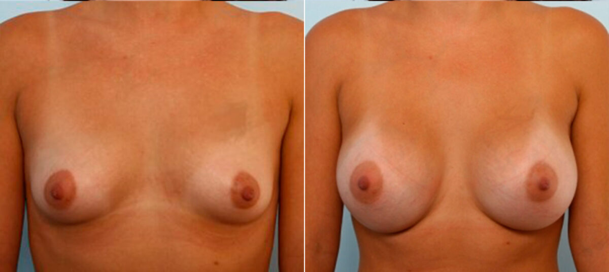 Breast Augmentation before and after photos in Houston, TX, Patient 25042