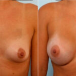 Breast Augmentation before and after photos in Houston, TX, Patient 25042