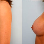Breast Augmentation before and after photos in Houston, TX, Patient 25053