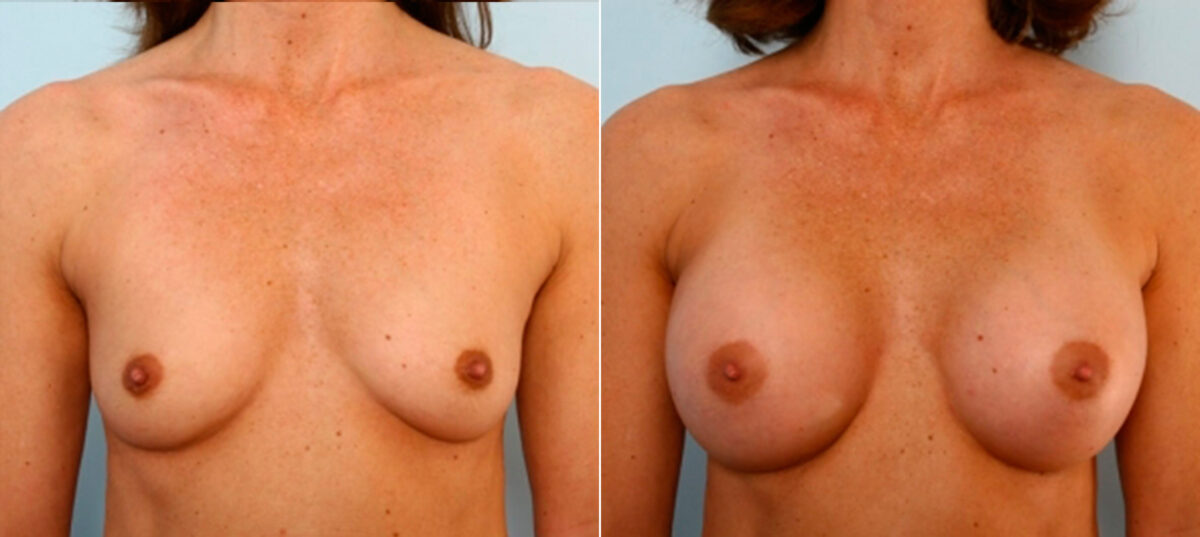Breast Augmentation before and after photos in Houston, TX, Patient 25053