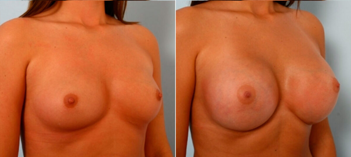 Breast Augmentation before and after photos in Houston, TX, Patient 25064