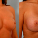 Breast Augmentation before and after photos in Houston, TX, Patient 25064