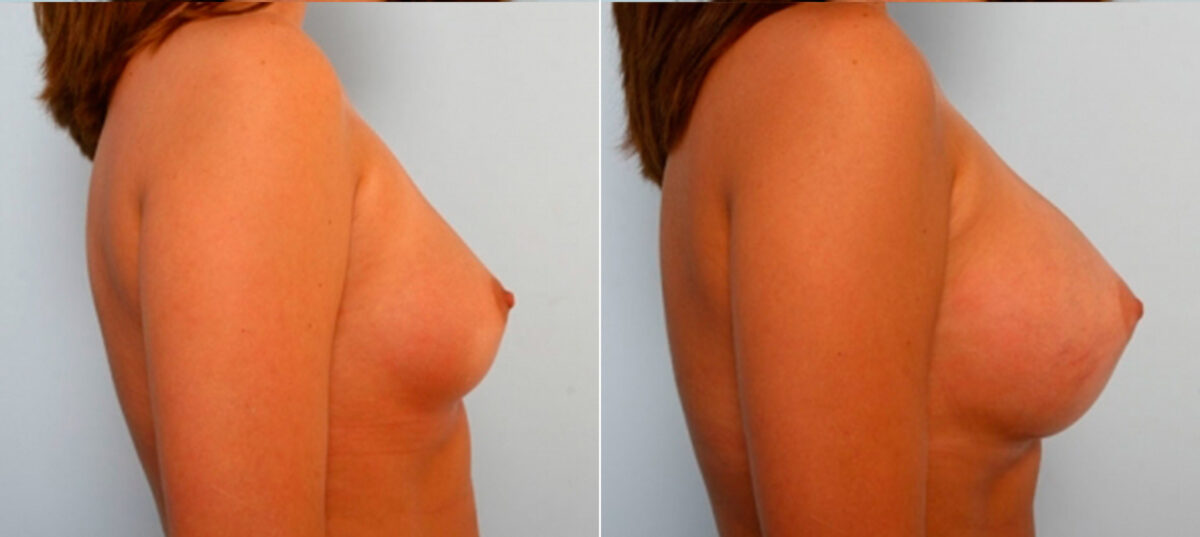 Breast Augmentation before and after photos in Houston, TX, Patient 25064