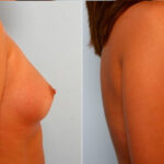 Breast Augmentation before and after photos in Houston, TX, Patient 25064