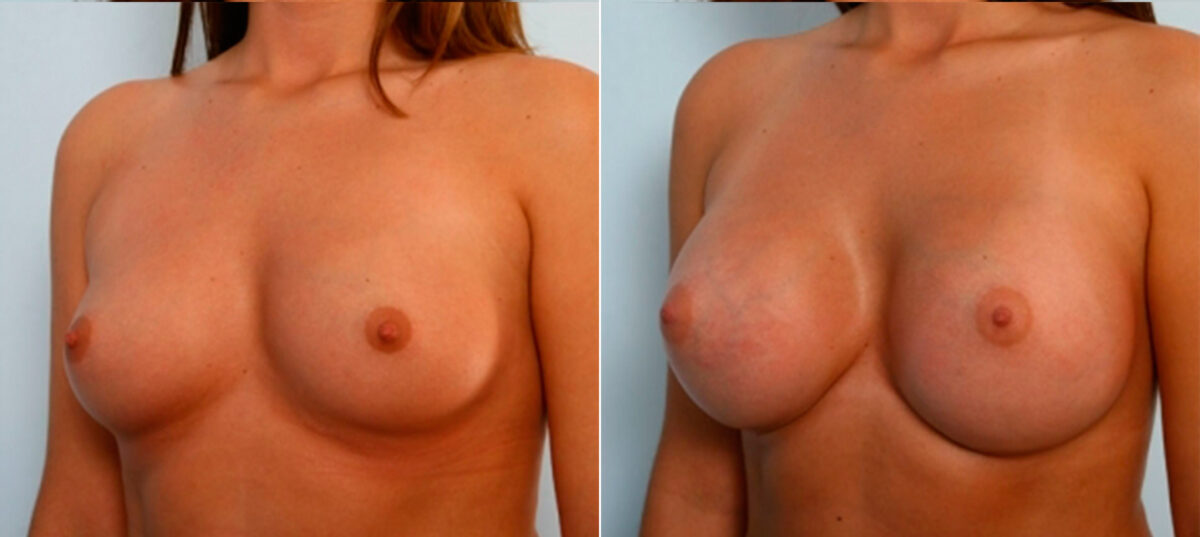 Breast Augmentation before and after photos in Houston, TX, Patient 25064