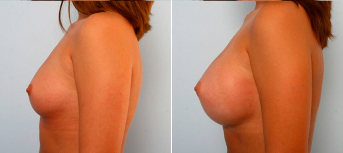 Breast Augmentation before and after photos in Houston, TX, Patient 25064