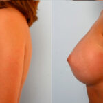 Breast Augmentation before and after photos in Houston, TX, Patient 25064