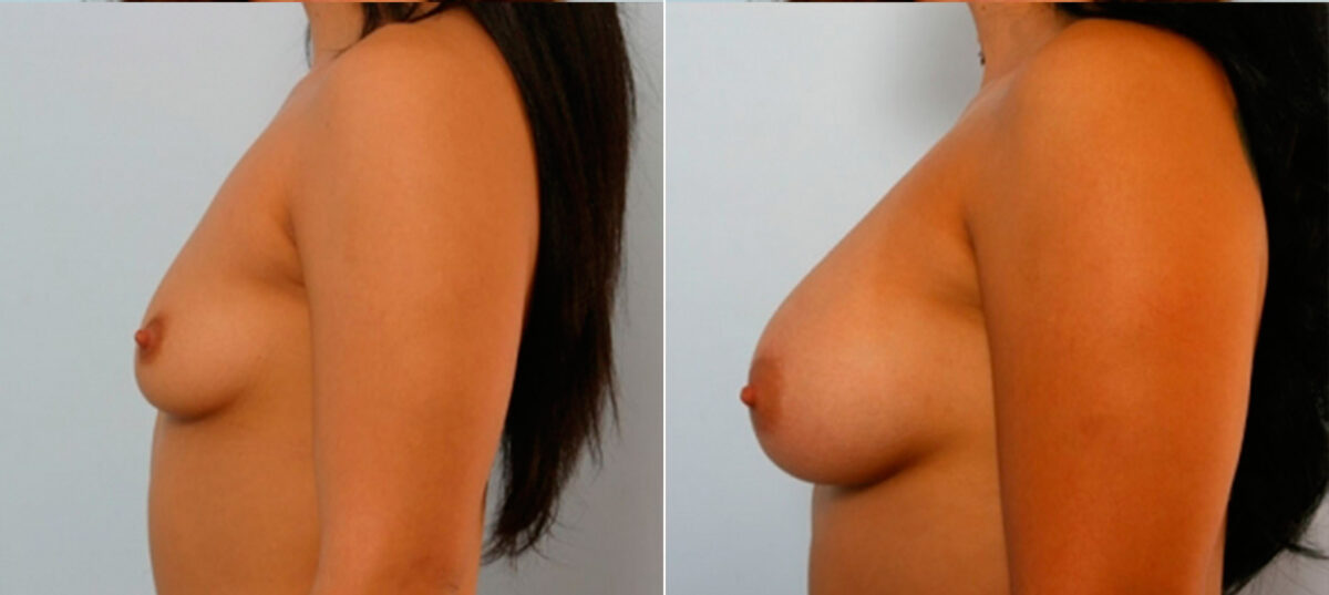 Breast Augmentation before and after photos in Houston, TX, Patient 25075