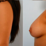 Breast Augmentation before and after photos in Houston, TX, Patient 25075