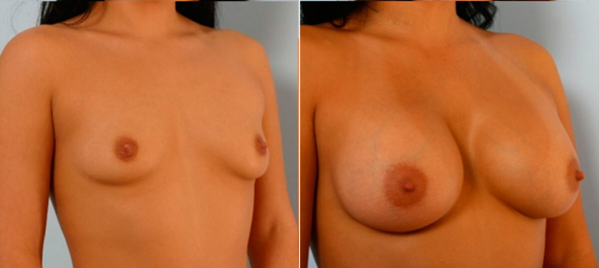 Breast Augmentation before and after photos in Houston, TX, Patient 25075