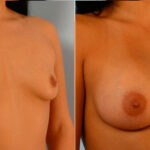 Breast Augmentation before and after photos in Houston, TX, Patient 25075