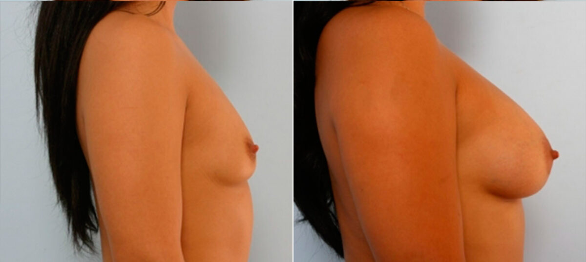 Breast Augmentation before and after photos in Houston, TX, Patient 25075