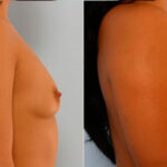 Breast Augmentation before and after photos in Houston, TX, Patient 25075