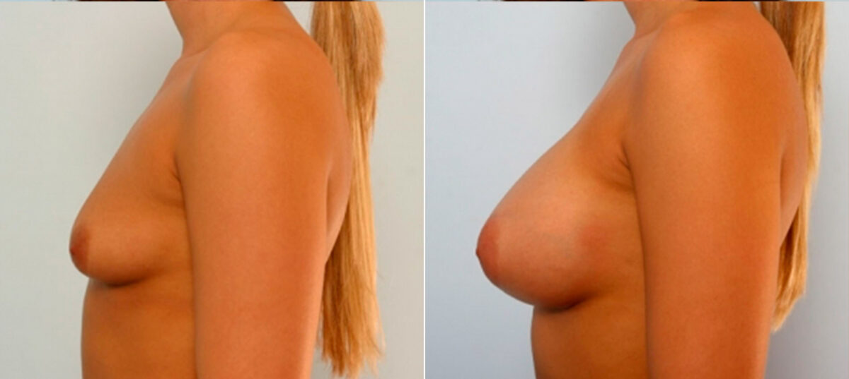 Breast Augmentation before and after photos in Houston, TX, Patient 25086