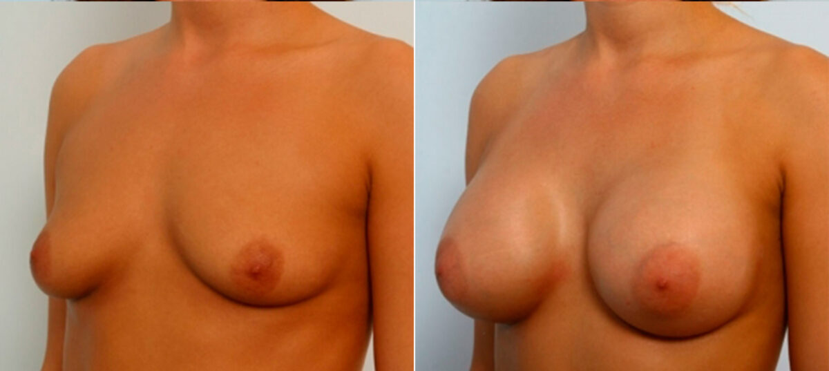 Breast Augmentation before and after photos in Houston, TX, Patient 25086