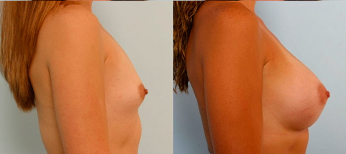 Breast Augmentation before and after photos in Houston, TX, Patient 25097