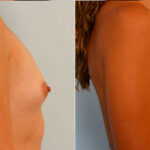 Breast Augmentation before and after photos in Houston, TX, Patient 25097