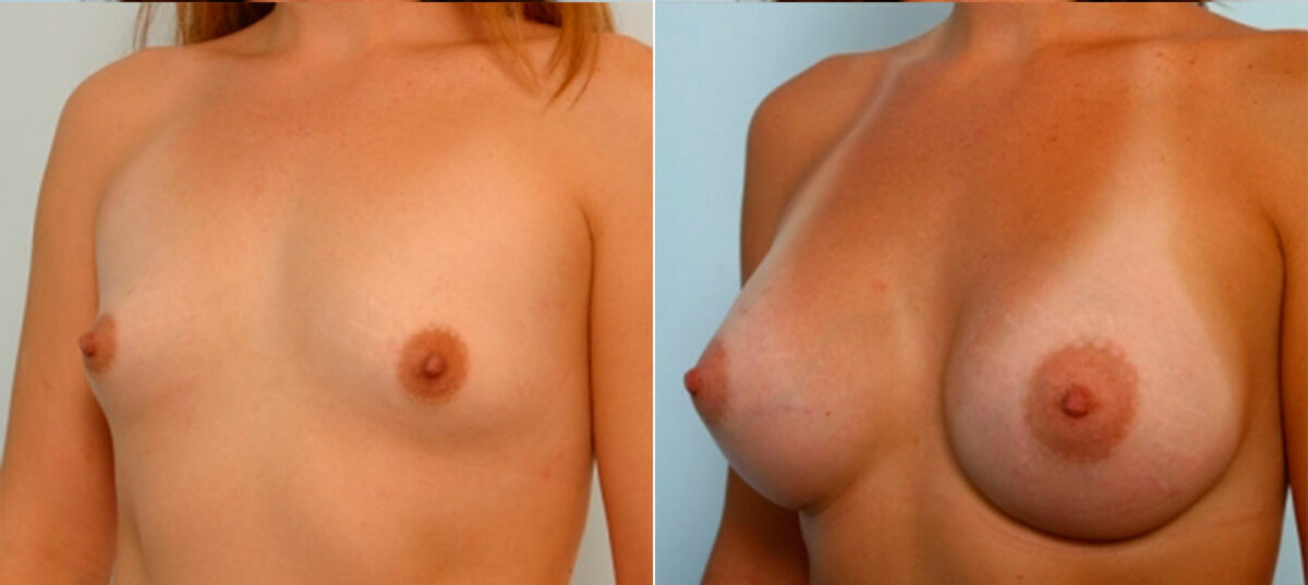 Breast Augmentation before and after photos in Houston, TX, Patient 25097