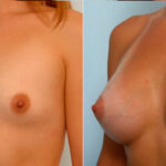 Breast Augmentation before and after photos in Houston, TX, Patient 25097